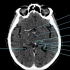 2.颅脑CT解剖图谱-脑室脑池CT解剖