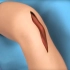 3D视频演示人工膝关节置换过程！