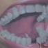 假牙的几种类型，看完你还不会选吗？