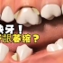 口腔动画：缺牙导致牙龈萎缩！