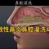 【医学科普】过敏性鼻炎鼻腔灌洗动画