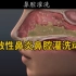 【医学科普】过敏性鼻炎鼻腔灌洗动画