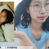 我和手汗症的那10年！胸腔镜下双侧胸三交感神经切断术