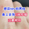 感染hpv的男性，身上会有2种疙瘩，注意辨别