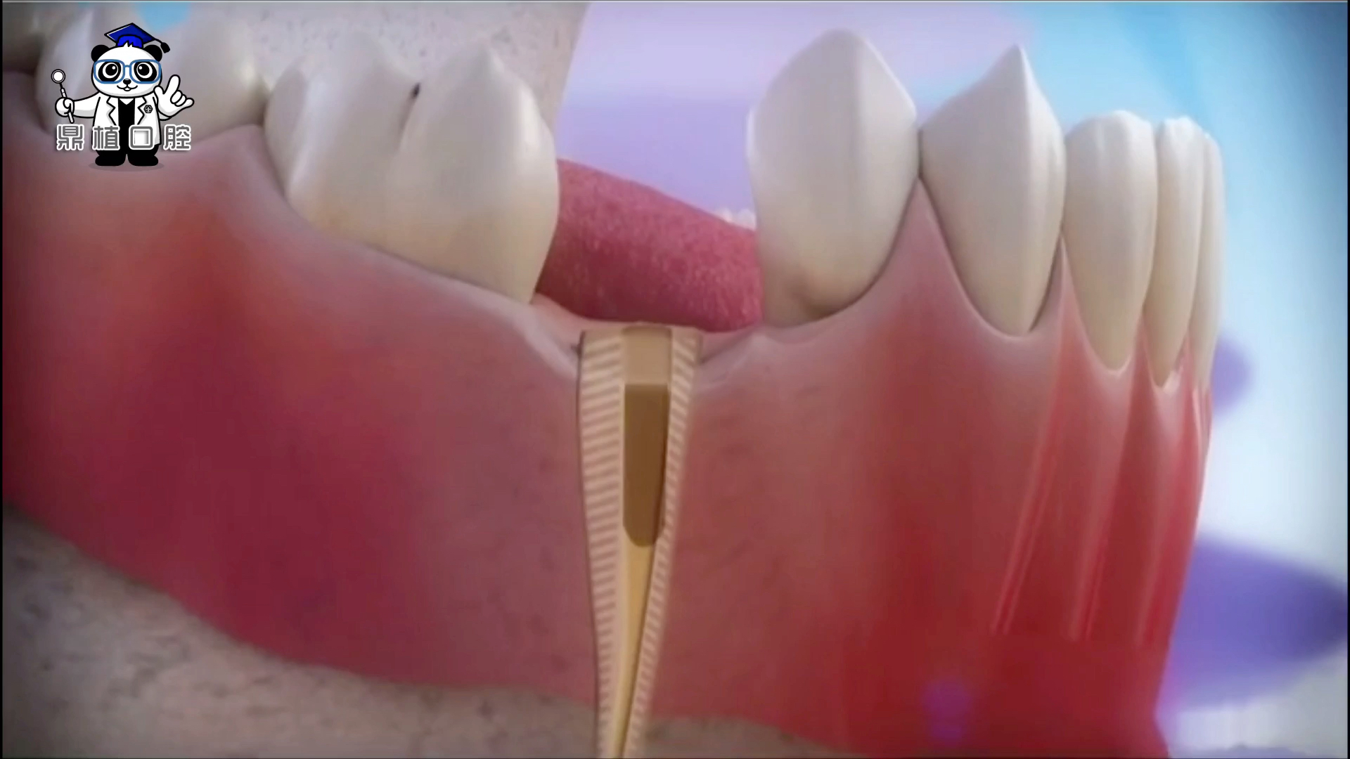 牙齿烂的只剩牙根了怎么办？