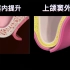3D医学动画--种植牙上颌窦内提升术与上颌窦外提升术的区别与用途