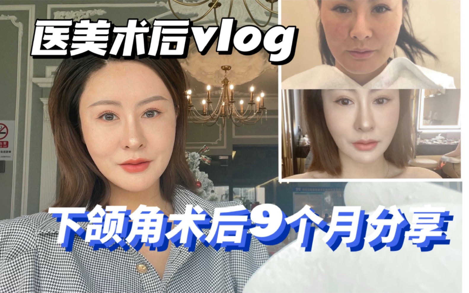 【下颌角术后】田公子轮廓手术术后9个月分享,做完手术9个月的状态反馈.哔哩哔哩bilibili