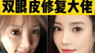 国内<em class="keyword">双眼皮修复</em>大佬合集！ 功课+避雷