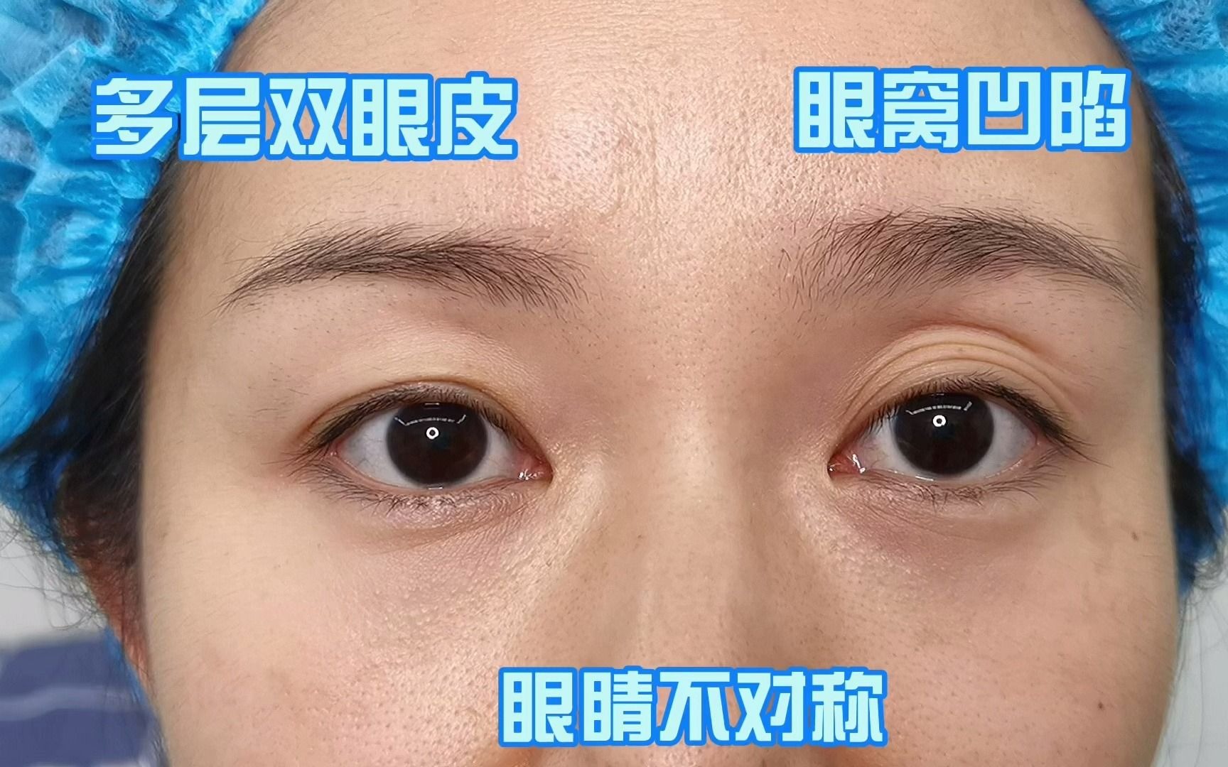 眼窝凹陷多层双眼皮双眼不对称的女士半年后改变很大