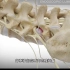 上帝视角看椎间孔镜腰椎间盘突出手术过程，3D演示。。