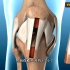 罗纳尔多经历的手术，膝关节十字韧带断裂修复手术，3D演示。。