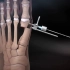 大脚骨的矫正手术过程，3D演示。。
