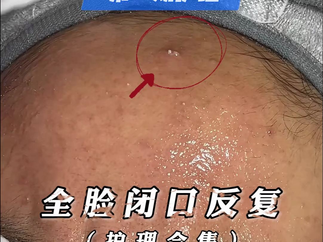 像“爆米花”一样爆出来的闭口，来看看经过三次护理“爆米花”还在不在~