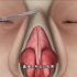 看了还敢做这手术吗，驼峰鼻整形手术过程，3D演示。。