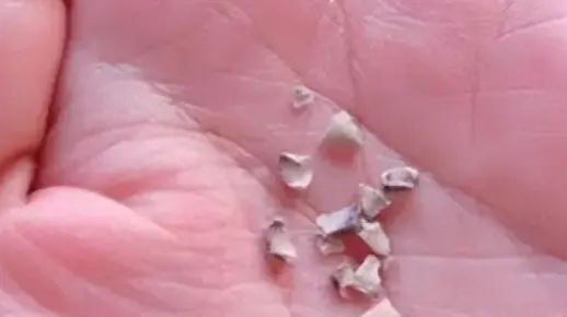 梦回牙间瓜子皮，解析梦见牙齿里塞了瓜子皮，用指甲扣掉后牙齿竟脱落的深层含义