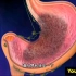 胃癌的发生过程，3D演示。。