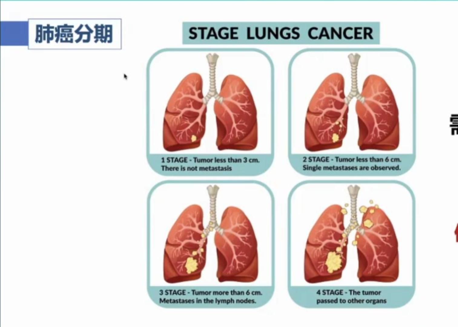 [干货] 6分钟看懂肺癌分期