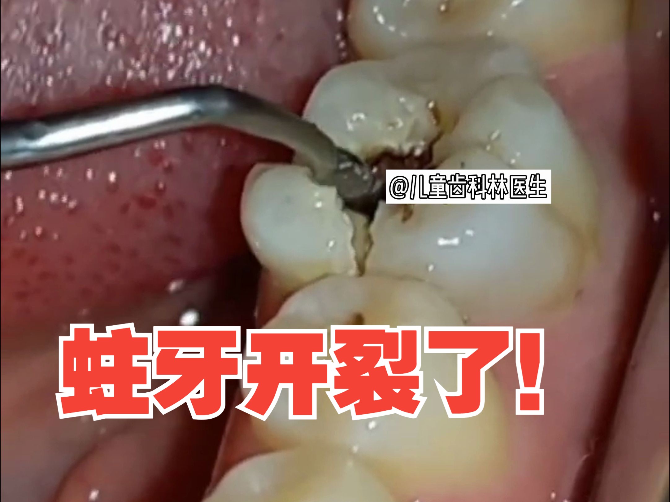 不好好爱护牙齿的后果：导致牙齿蛀得都裂开了！