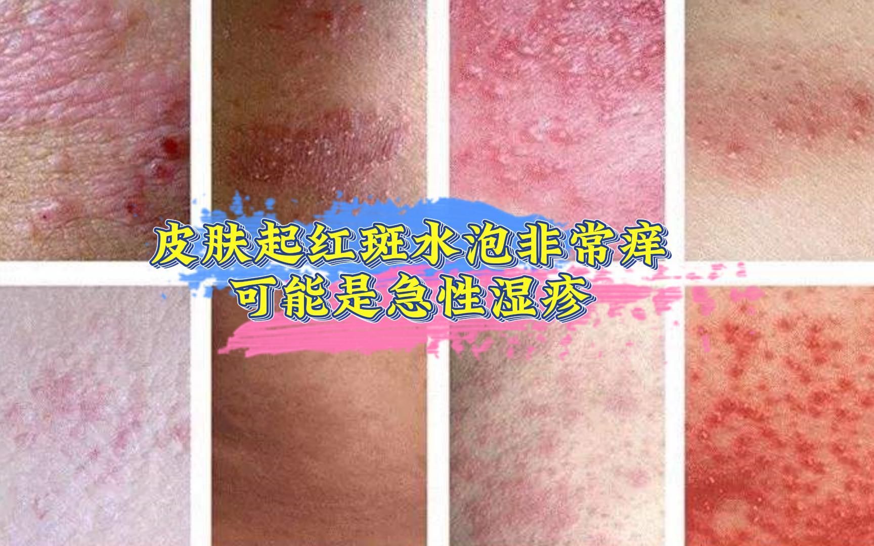 皮肤起红斑水泡非常痒 可能是急性湿疹