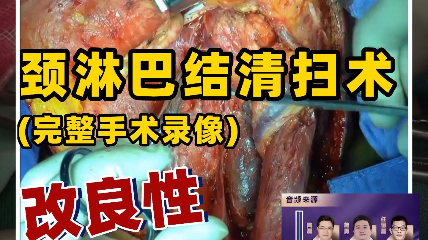 【咽喉头颈进阶篇】改良性颈淋巴结清扫术——耳鼻咽喉手术精讲（进阶篇）