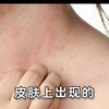 NO75：皮肤瘙痒起红疹 教你这样处理