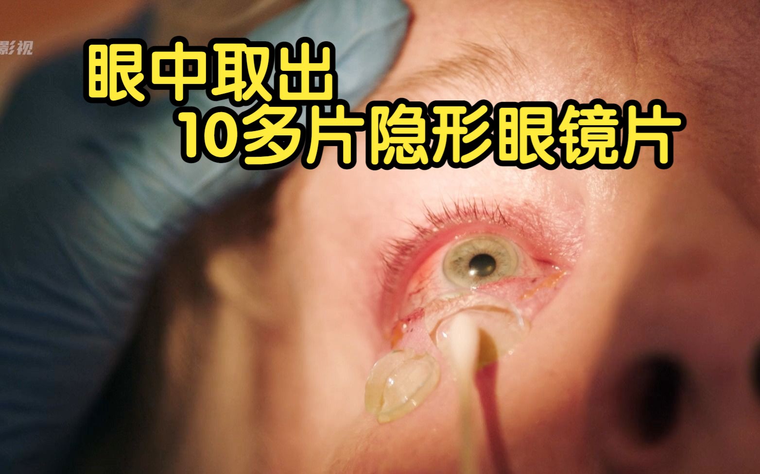 老妇眼中取出十多片隐形眼镜片