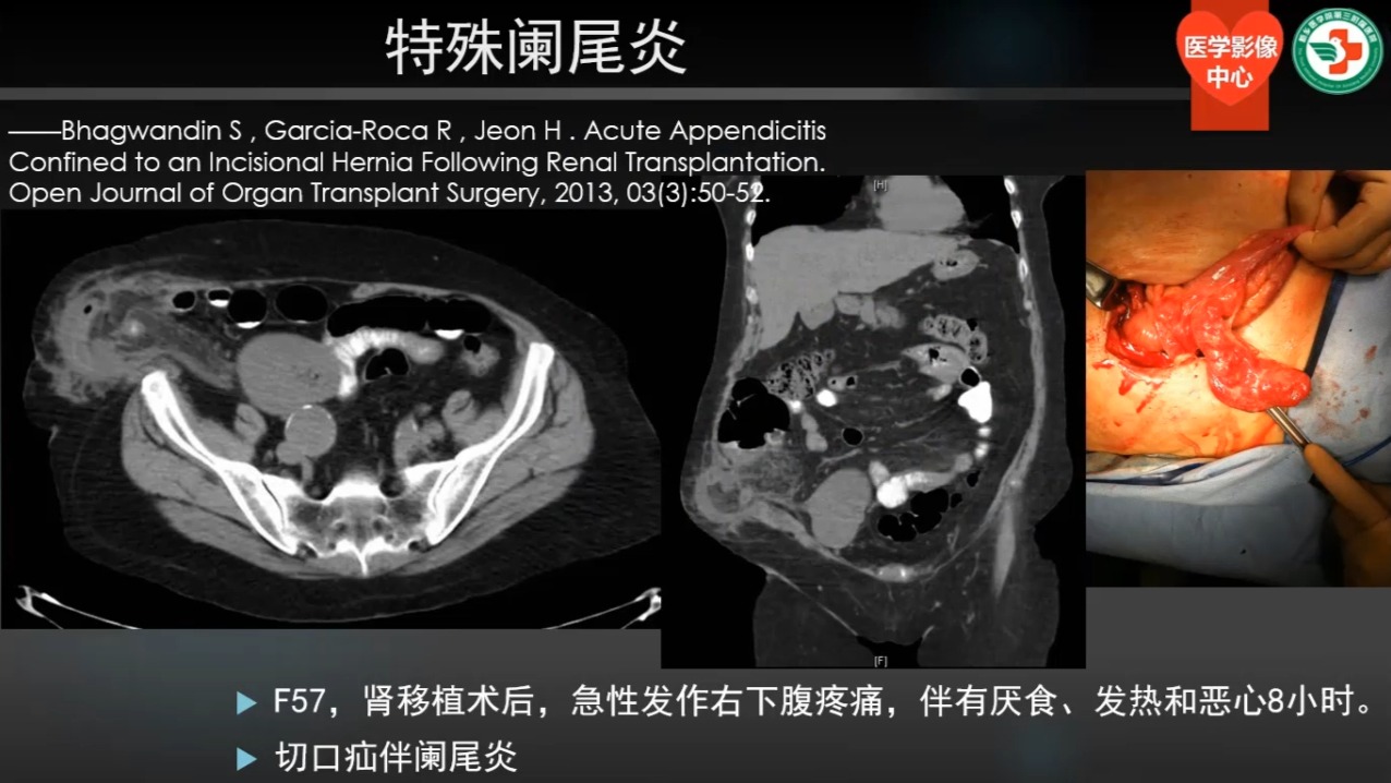 第三讲、急性阑尾炎02（共30讲）