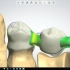 牙宝带你学习如何用3shape软件设计后牙内冠桥