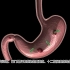 3D建模医学科普 —— 胃溃疡／十二指肠溃疡