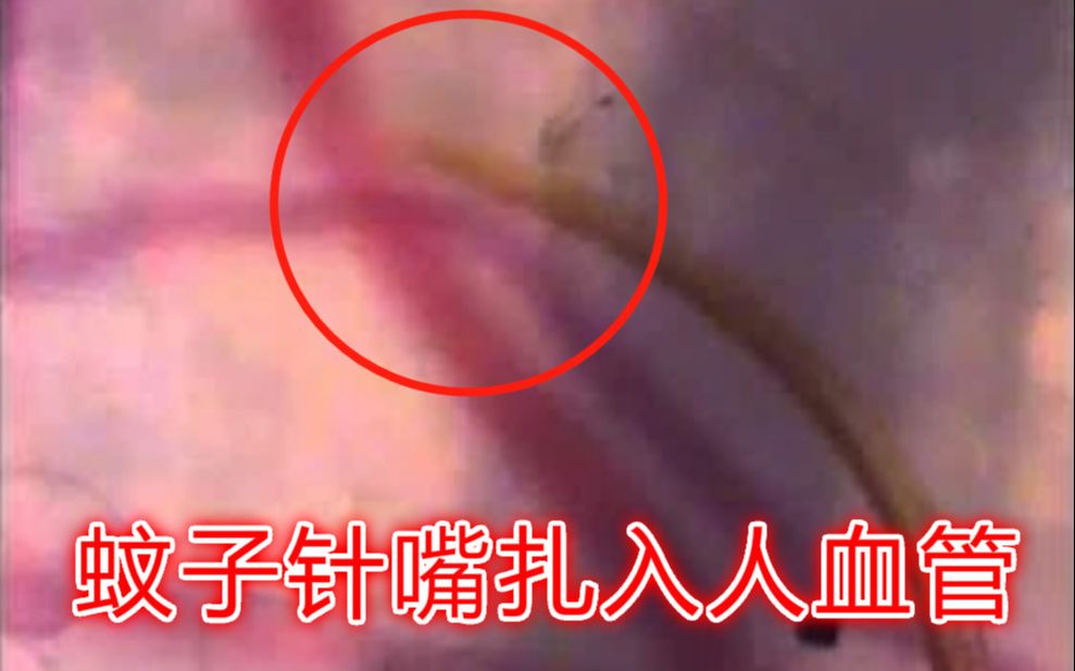 实拍一只蚊子把针嘴插入人的血管瞬间把血吸干爆缩全过程油兔不二字幕