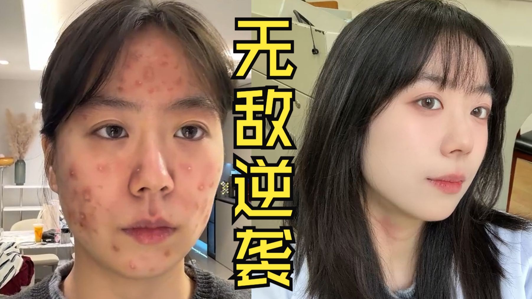 【纯干货】医学生来拯救你的痤疮痘痘肌啦!!!