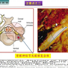 椎间孔镜下颈椎减压
