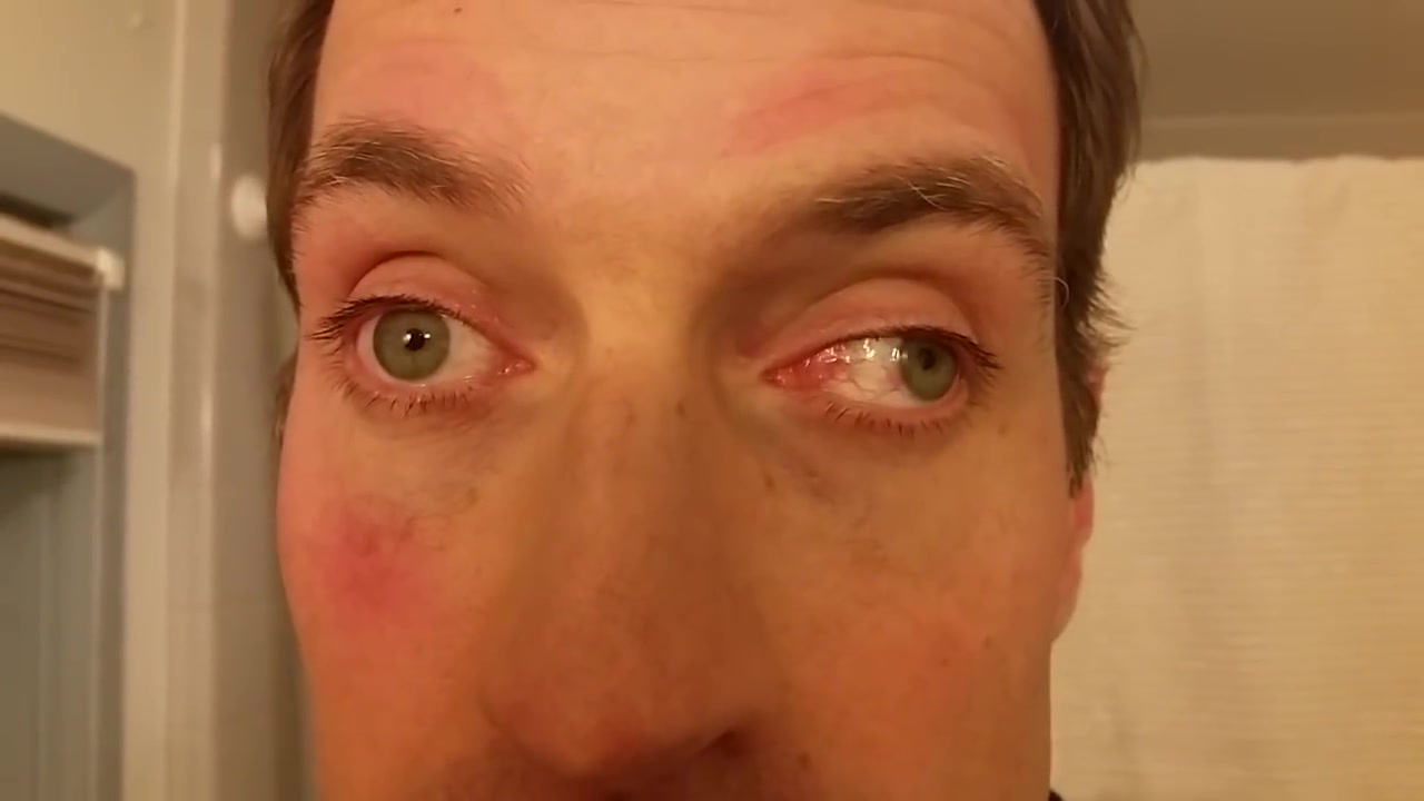 核间性眼球麻痹的临床表现