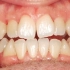 沉浸式整牙，牙齿前后对比变化
