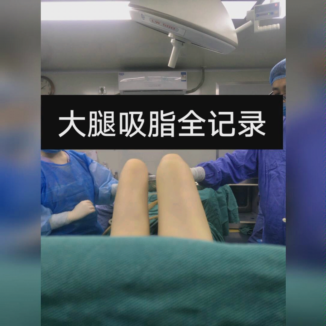 大腿吸脂大腿环吸抽脂手术减肥医疗美容整形整容分享vlog真人案例