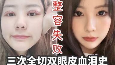 三次<em class="keyword">双眼皮修复</em>经历｜现在化妆还要贴<em class="keyword">双眼皮</em>贴的心酸！