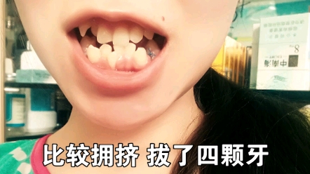 隐形牙套1-45副牙齿变化