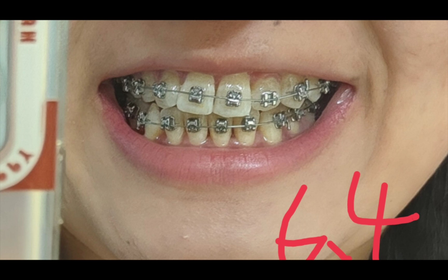 金属自锁牙套三个月整牙记录，基本上整齐了!