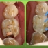 北大口腔医院赵奇——光固化复合树脂充填及美容修复规范化操作（2）