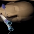医学动画：通过VATS手术进行右肺气肿大疱切除