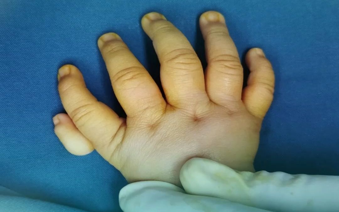 5根手指一样长，手术帮孩子重建大拇指