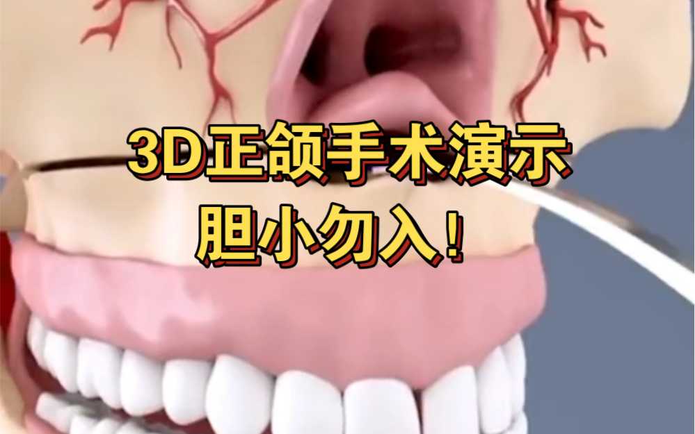 吓鼠我了！3D动画演示正颌手术！要做正颌的进来看看！