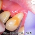 日本大叔45年来第一次洗牙，口内存在大量牙结石！