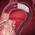 原创科普医学动画连载014—主动脉夹层介入治疗