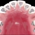 舌侧矫正是人类发明牙套以来隐蔽性最好、技术难度最高的矫正方式，是真正意义上实现完全隐形的牙套