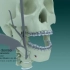 面部整容之地包天整形手术过程，3D演示。。