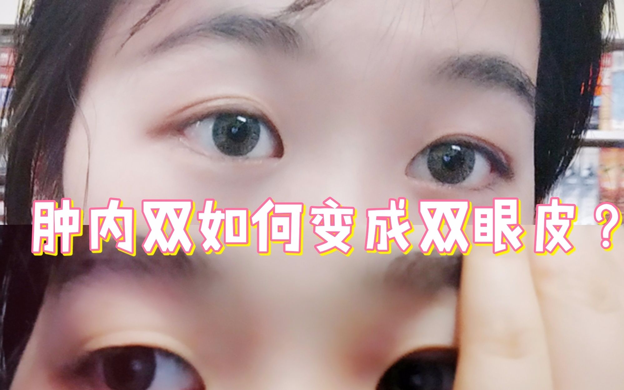 肿内双变双眼皮!只要一分钟