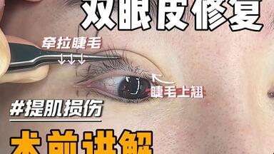 宽改<em class="keyword">窄修复</em>｜术前讲解✅ <em class="keyword">双眼皮修复</em>·宽改窄 提肌损伤➿睫毛过翘·睑缘外翻 术前讲解