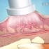 3D视频演示：HPV感染常见皮肤病（疣）