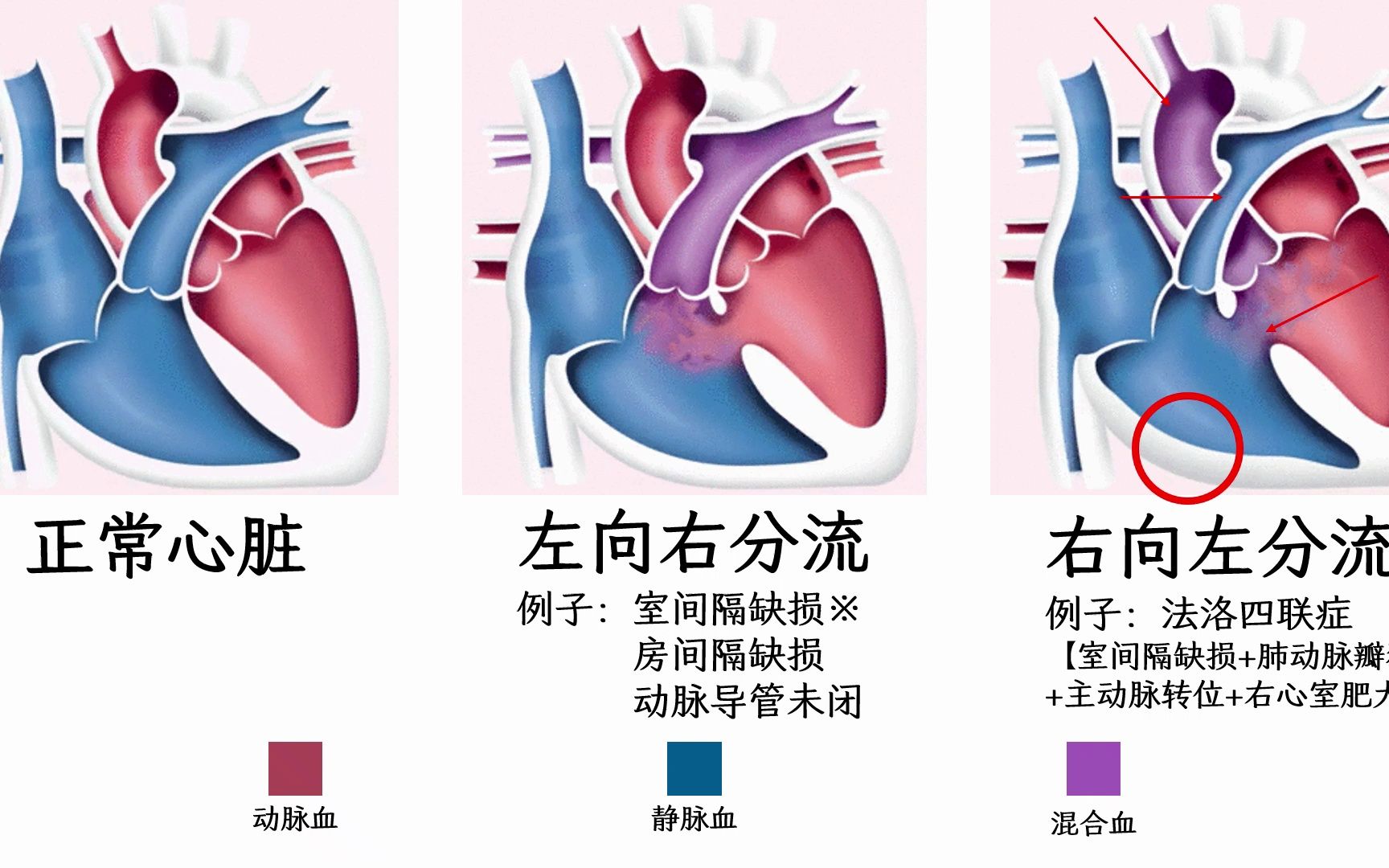 【心衰病因2-2-1】室间隔缺损（容量负荷增加-右心室容量负荷增加-室间隔缺损）